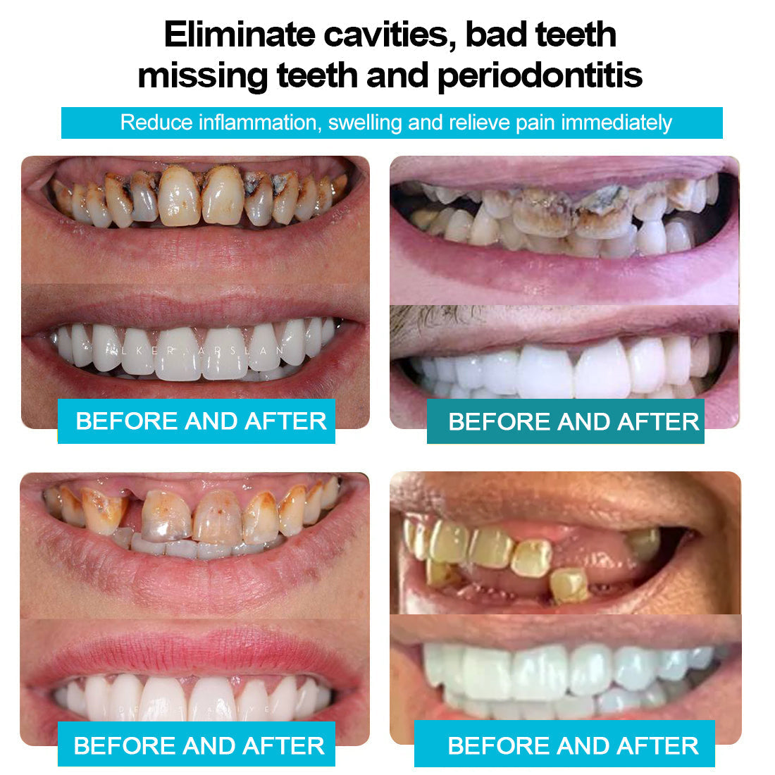 ADA Recommended Smilehpy™ Silicone Reline Denture Set