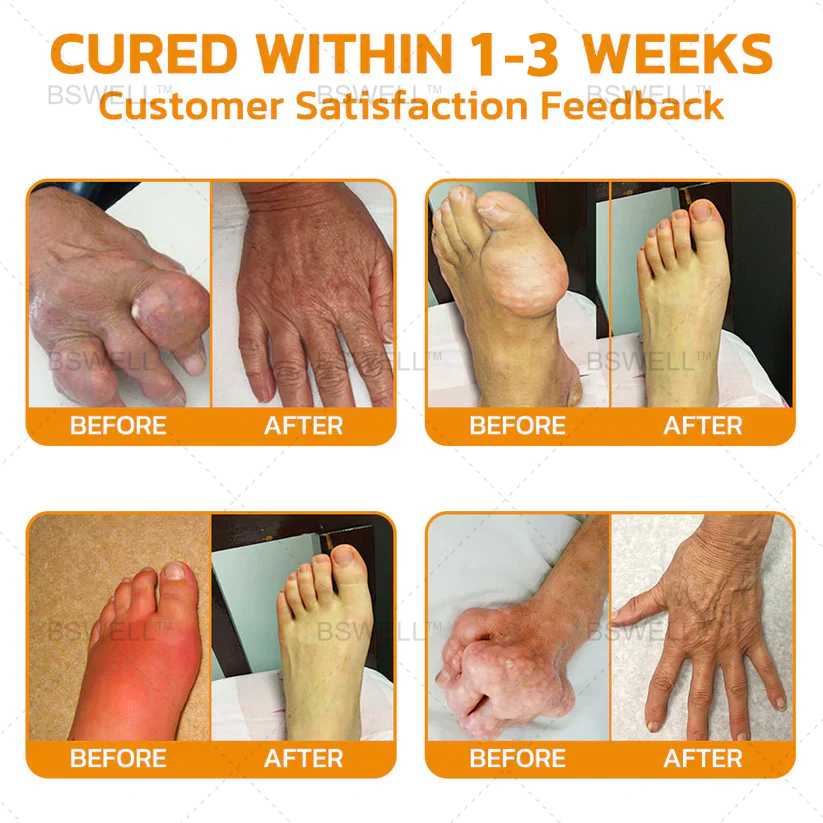 Only 5 bottles available! Get an exclusive 50% discount now! Instant pain relief, health without pain. Don't miss this opportunity—this offer won't be available again until next year. Act fast! 180-day money-back guarantee!